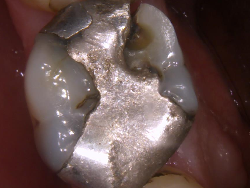 1-inlay-onlay-dentiste-beausoleil