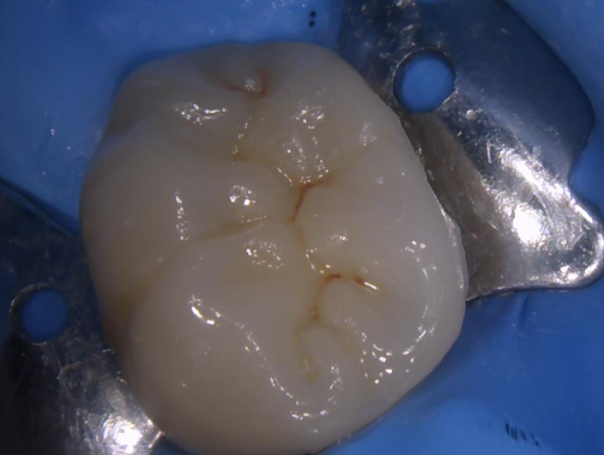 3-inlay-onlay-dentiste-beausoleil