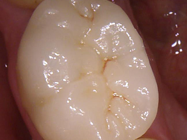 4-inlay-onlay-dentiste-beausoleil