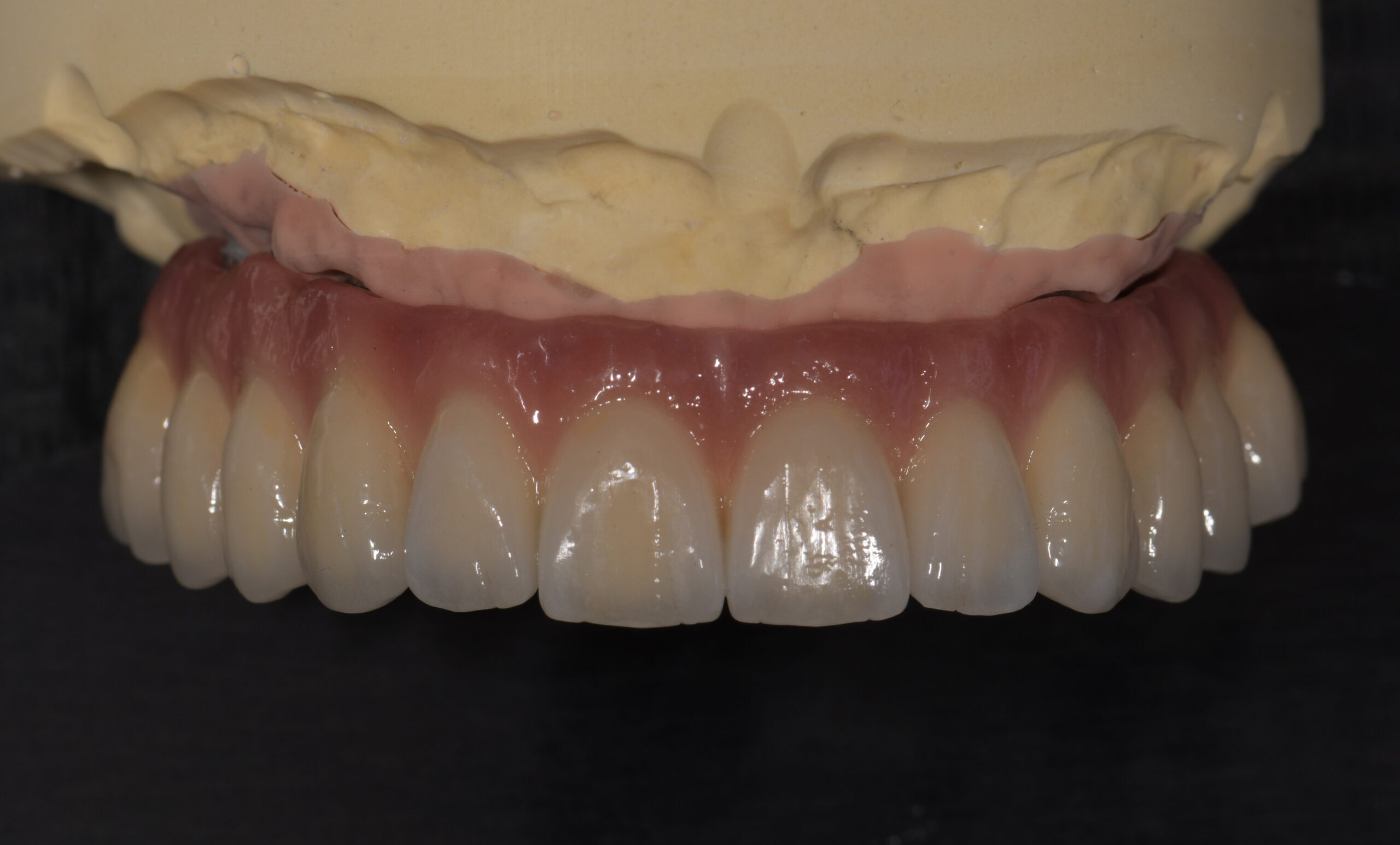 All-on-8 | Dr Sinnonio