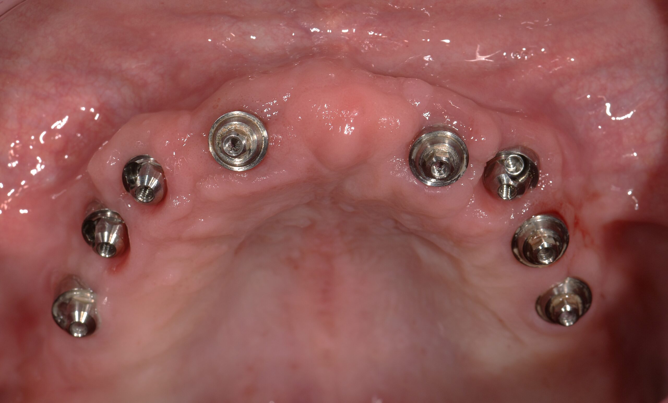 All-on-8 | Dr Sinnonio