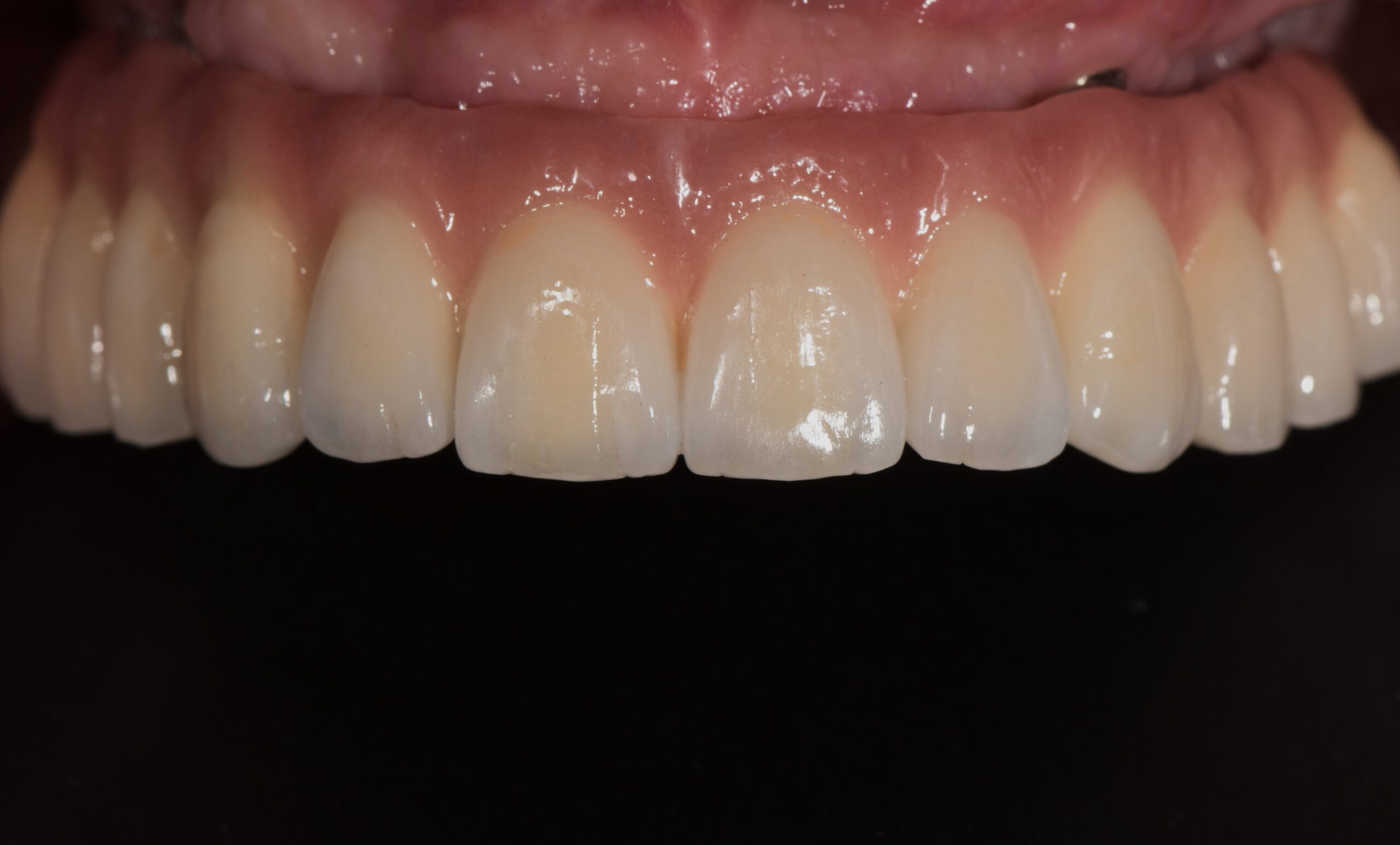 All-on-8 | Dr Sinnonio